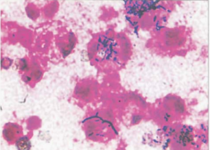 图 23 皮氏诺卡菌在腹水标本涂片中的镜下形态(革兰染色)