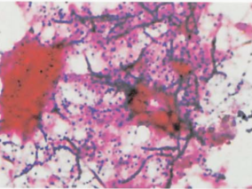 图 5 血培养阳性培养物直接涂片(革兰染色)