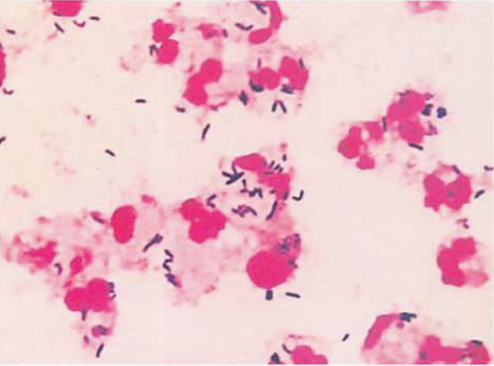 图 7 痰标本中纹带棒杆菌的镜下形态(革兰染色)