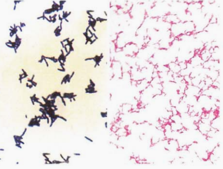 图 3 耳炎苏黎世菌与快速生长分枝杆菌(抗酸染色)左侧为耳炎苏黎世菌右侧为快速生长分枝杆菌