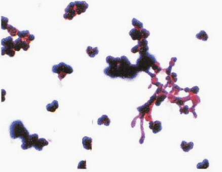 图 7刚果嗜皮菌皮肤组织直接涂片(吉姆萨染色)