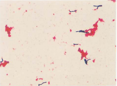 图 2 草绿色链球菌血培养阳性肉汤涂片的镜下形态(革兰染色)