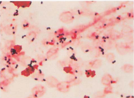 图 2 粪肠球菌血培养标本的涂片(革兰染色)