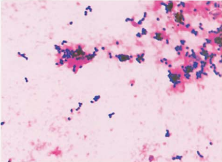 图 6 麻疹李生球菌血培养标本涂片(革兰染色)
