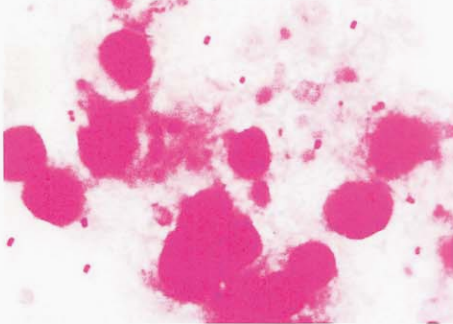 图 2脑膜炎奈瑟菌脑膜炎的脑脊液标本直接涂片(革兰染色)