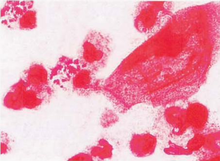 图 10女性急性淋病患者的阴道分泌物标本直接涂片显示白细胞内存在革兰阴性双球菌，但白细胞较多，上皮细胞较少