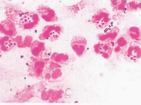 图 8男性急性淋病患者的尿道分泌物标本直接涂片显示白细胞内挤满了革兰阴性双球菌，表现为典型的淋病奈瑟菌的特征
