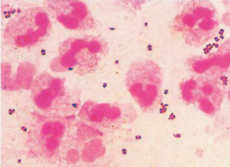 图 9男性慢性淋病患者的尿道分泌物标本直接涂片显示白细胞较少，革兰阴性双球菌位于白细胞外