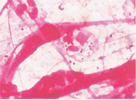 图 3痰标本中脑膜炎奈瑟菌的镜下形态(革兰染色)(深圳市第二人民医院吴瑾滨提供)