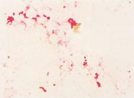 图 4血培养阳性标本中脑膜炎奈瑟菌的镜下形态(革兰染色)