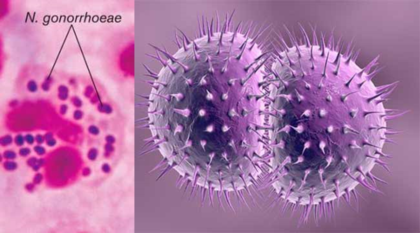 淋病奈瑟菌（Neisseria gonorrhoeae）